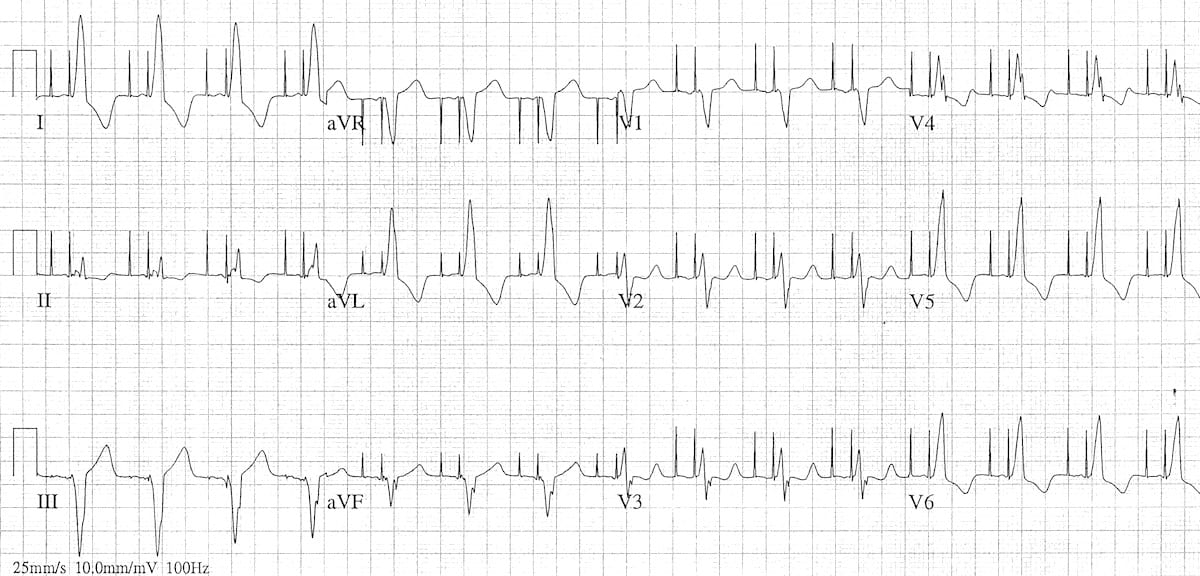 AV-sequential-pacing-3 2