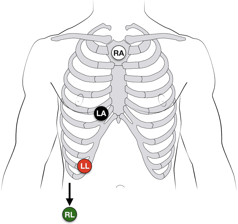 Lewis Lead ECG placement AV dissociation