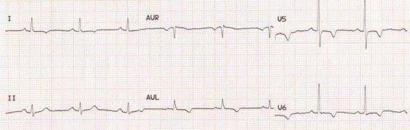 Lateral; leads T wave inversion acute ischaemia
