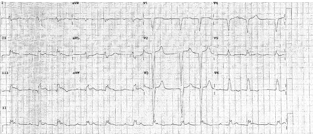 Sgarbossa modified Inferior STEMI CHB 2