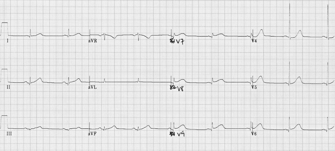 TOP 100 ECG QUIZ LITFL 067