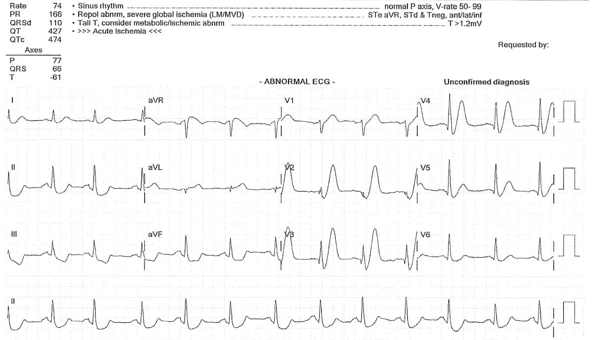ECG de Winter waves proximal LAD occlusion