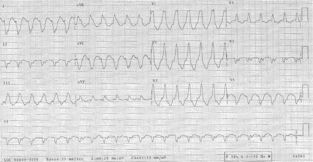 ECG VT or not VT