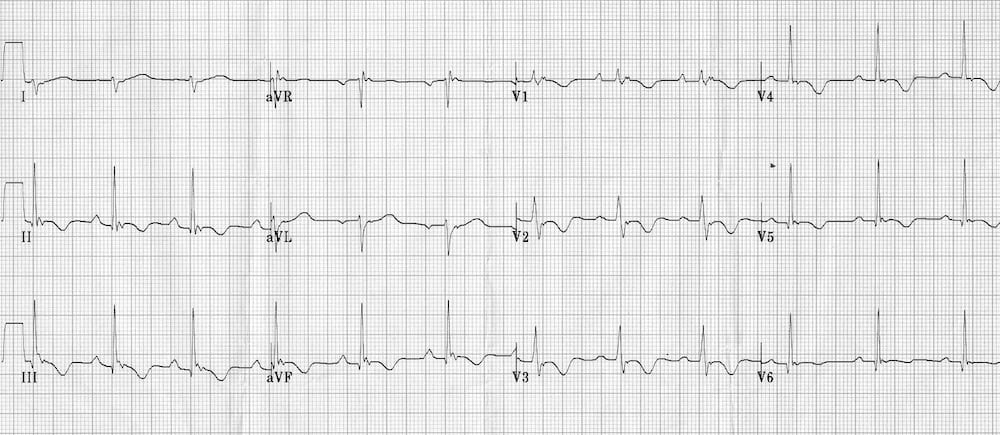 ECG exigency Sudden Syncope 003ECG exigency Sudden Syncope 003