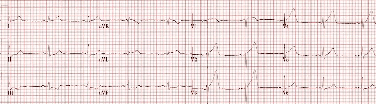 ECG Anterolateral STEMI Hyperacute