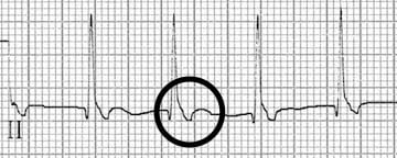 Inverted retrograde P waves in lead II