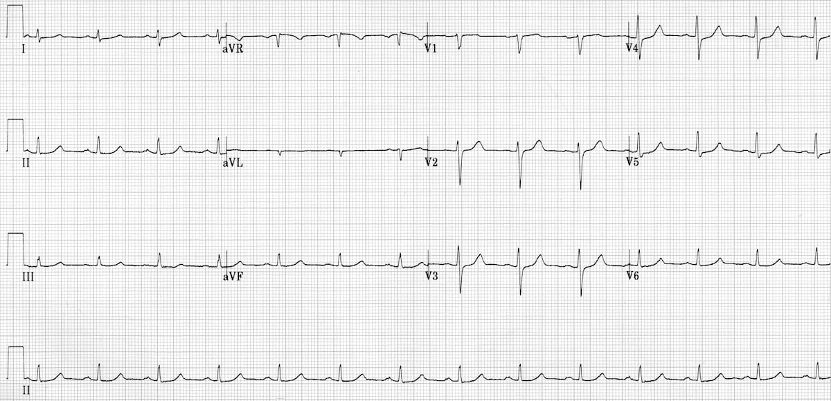 ECG Primary idiopathic fascicular VT 3b reversion