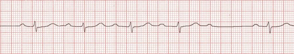 ECG Wenckebach Phenomenon