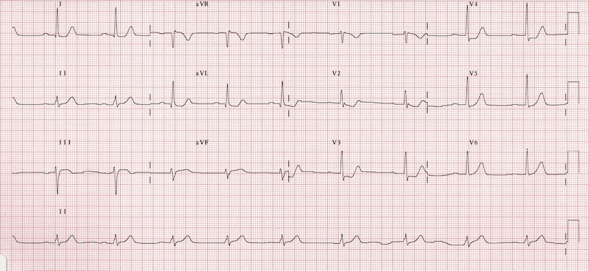 ECG Posterior AMI 2