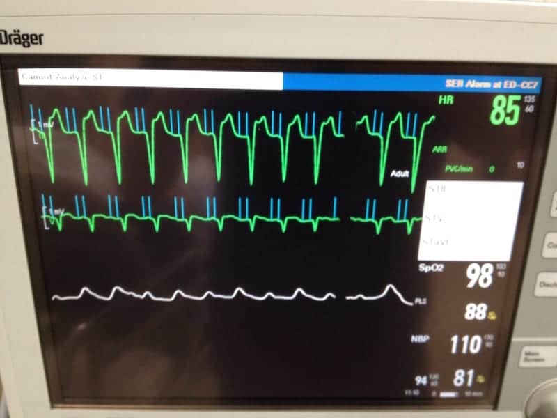 ECG Pacemaker Mediated Tachycardia PMT Magnet Mode
