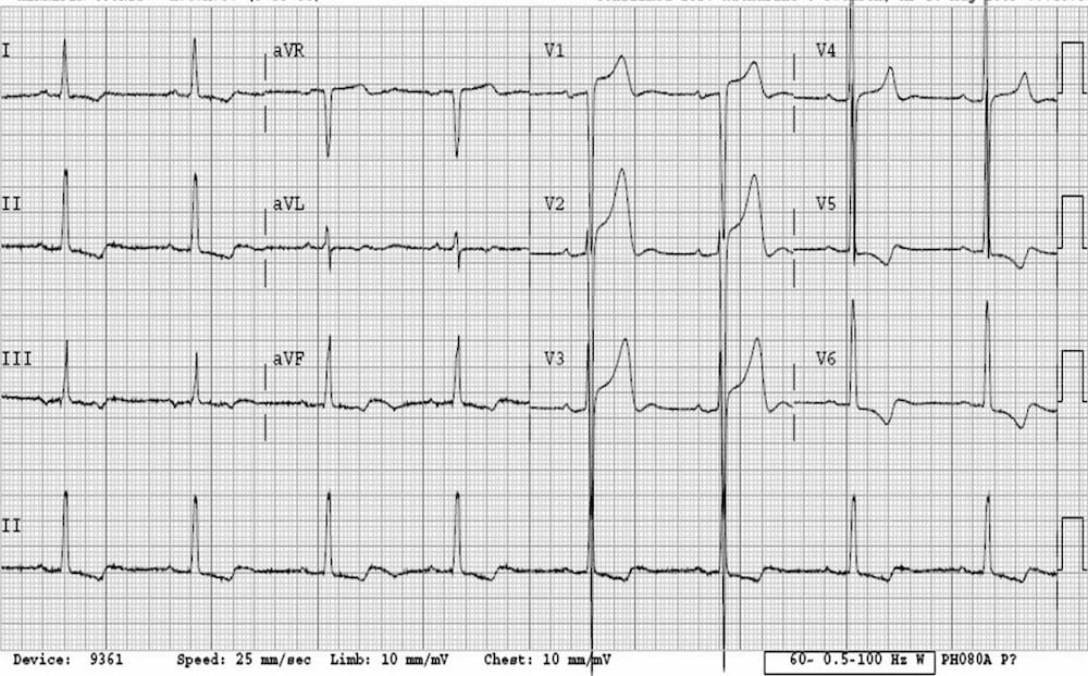 ECG LVH ST elevation not MI