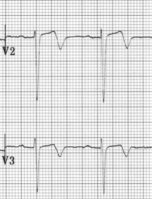 Wellens Pattern A Type 1 T wave