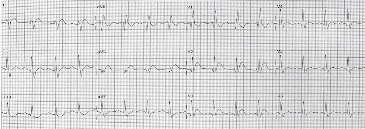 ECG High lateral STEMI 3