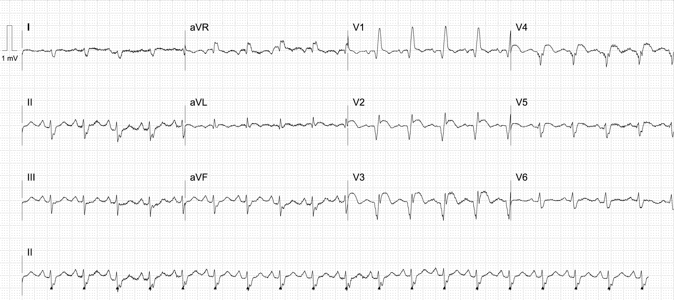 Left ventricular aneurysm 2022 17 02
