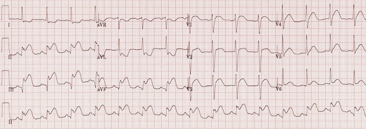 ECG Inferior AMI STEMI 2