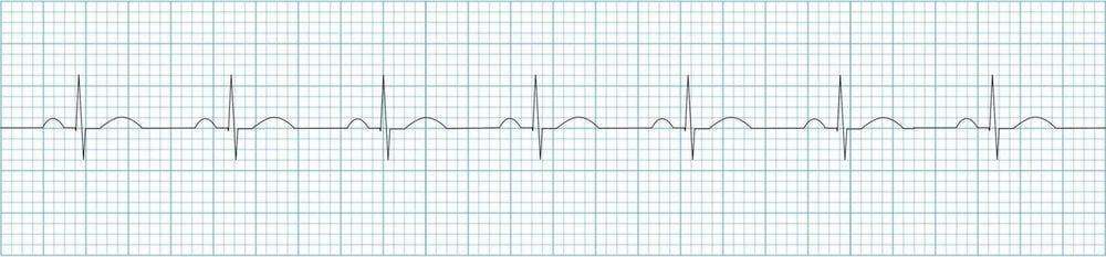 ECG Normal sinus rhythm strip