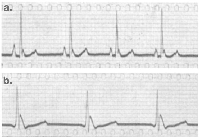 Hypothermia Osborn wave 1943