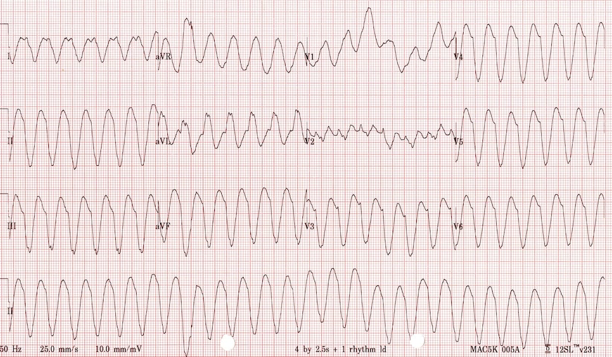 Monomorphic ventricular tachycardia VT 8