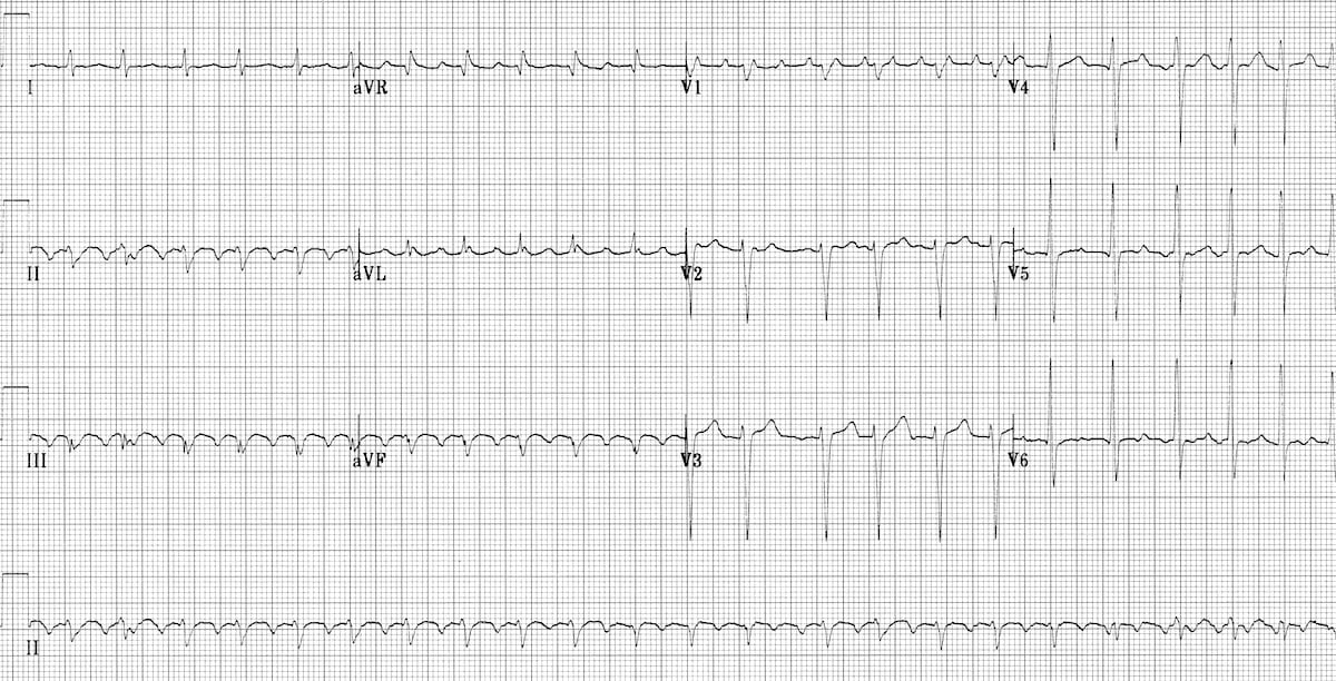 ECG Atrial Flutter with 2:1 Block 1