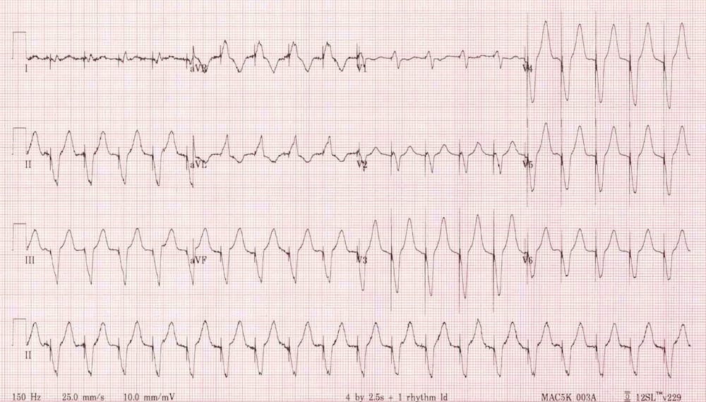 ECG pacemaker-mediated tachycardia PMT