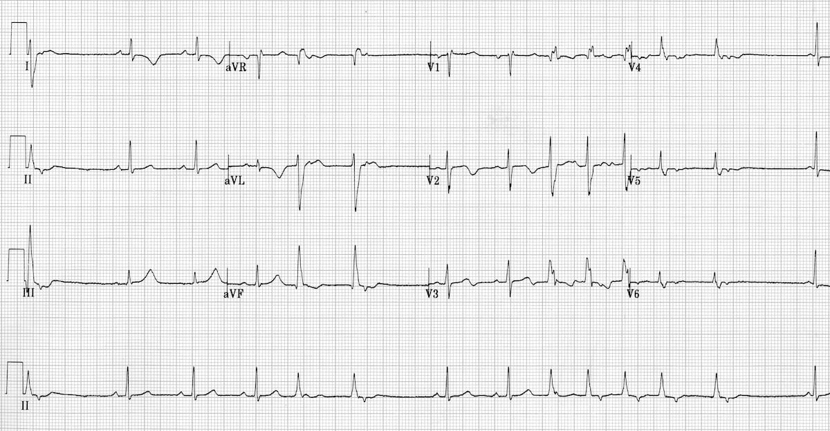 Idiopathic Fascicular Left Ventricular Tachycardia 2a