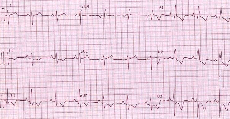 Right ventricular hypertrophy with T-wave inversion