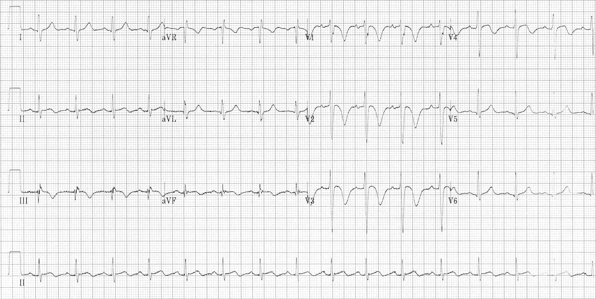 ECG Massive PE PTE pulmonary embolus 2