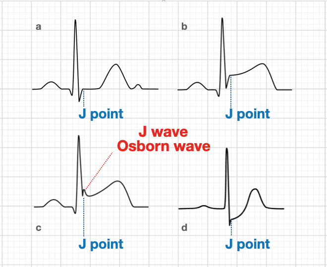 Osborn wave J point on ECG labelled