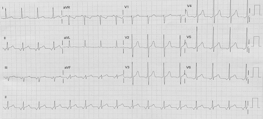 ECG Ectopic atrial tachycardia inverted p waves 2