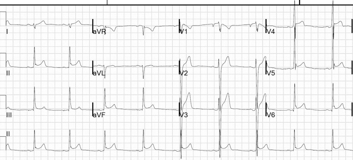 ECG Benign early repolarisation BER 5