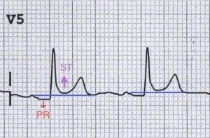 V5-pericarditis