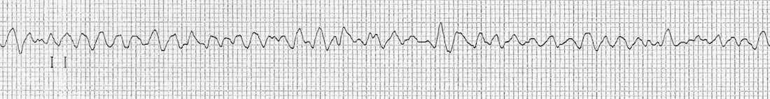 ventricular fibrillation rhythm strip VF