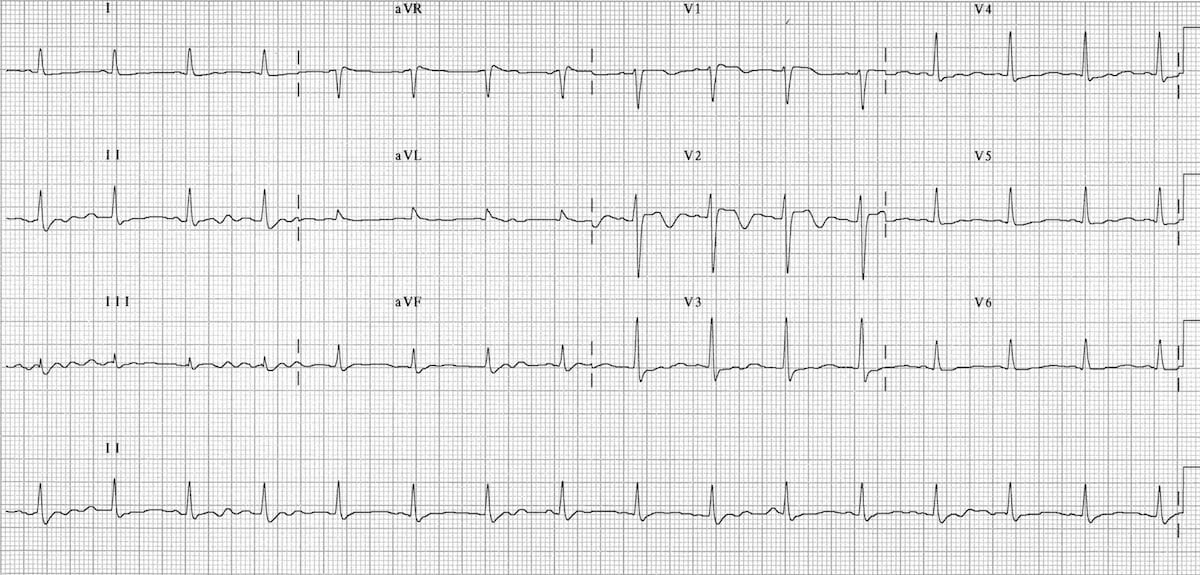 ECG TCA toxicity 3 resolution 2