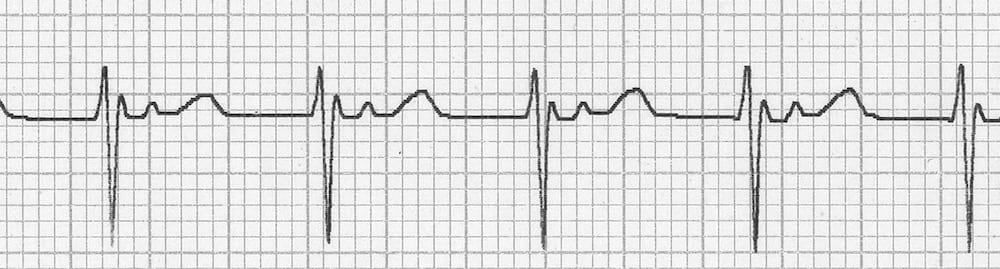 ECG AVNRT QRSPT retrograde P