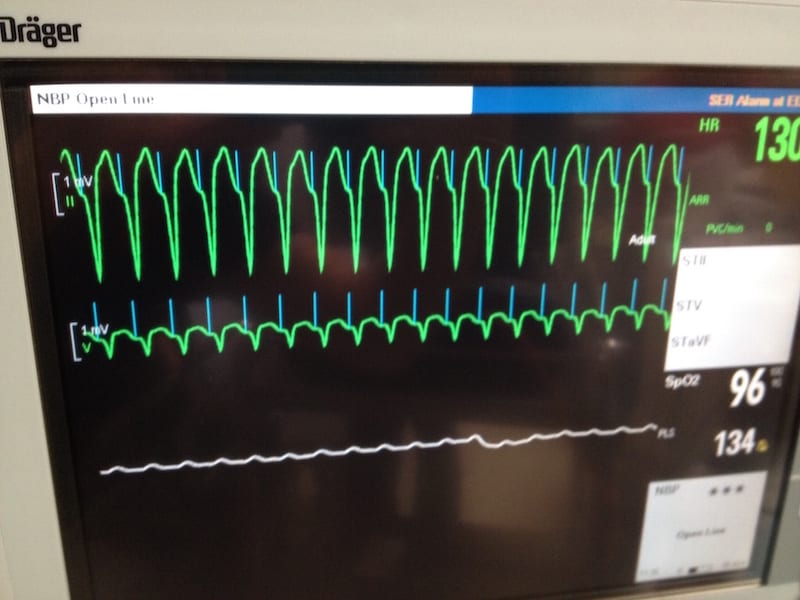 ECG Pacemaker Mediated Tachycardia PMT Monitor 1
