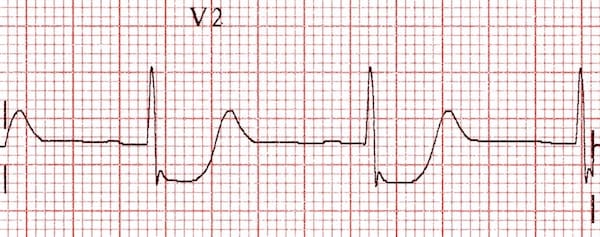ECG posterior infarction in V2