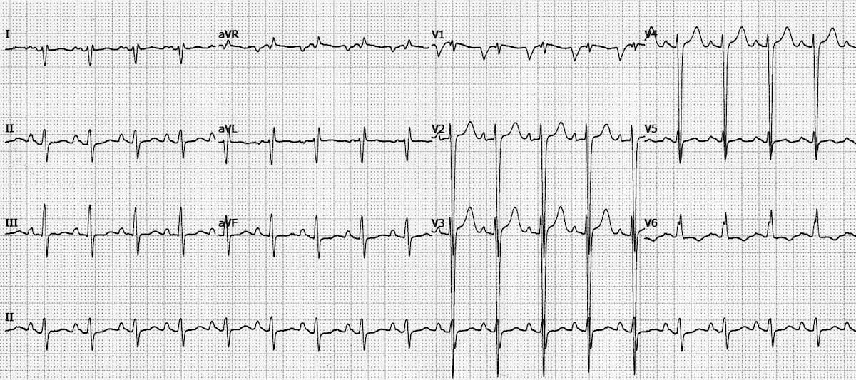 ECG Ischaemic dilated cardiomyopathy 1