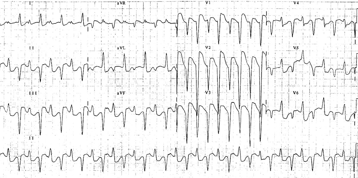 ECG Bidirectional ventricular tachycardia