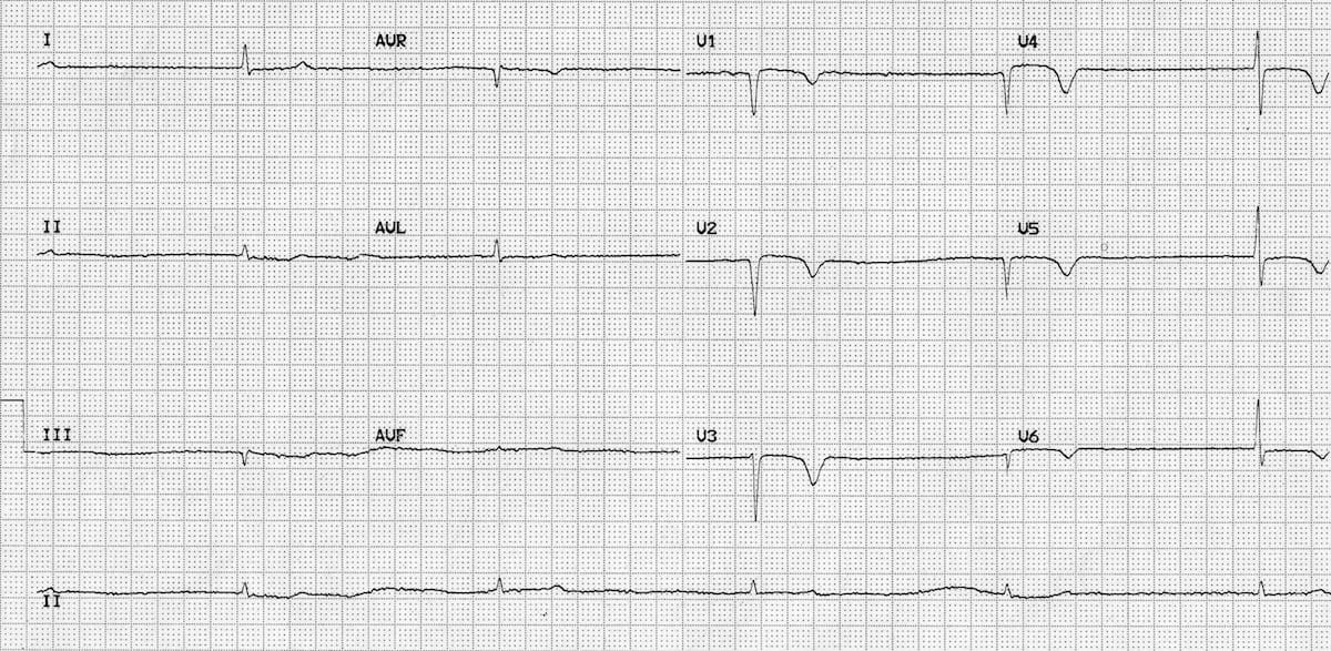 ECG hypothyroid myxoedema coma 1
