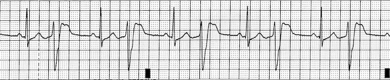 ECG Digoxin toxicity bigeminy