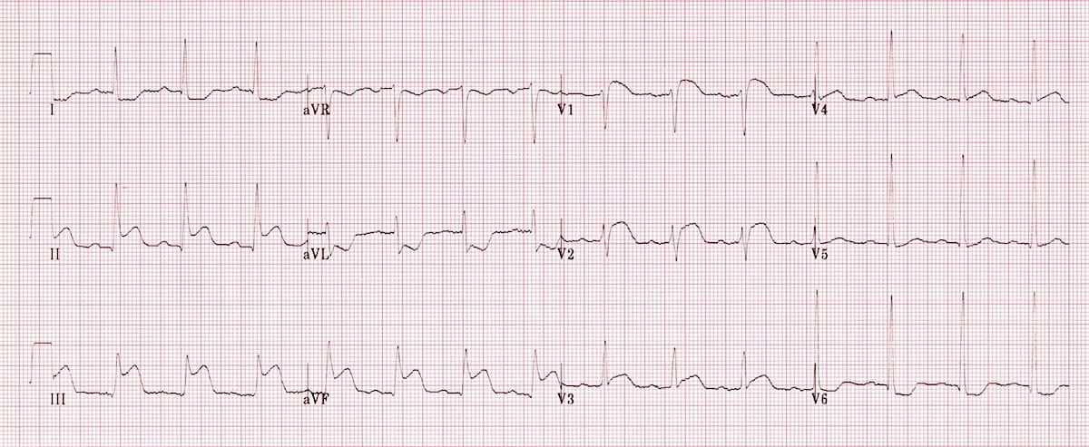 ECG Right ventricular infarction 1