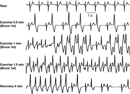 CPVT Catecholaminergic Polymorphic Ventricular Tachycardia