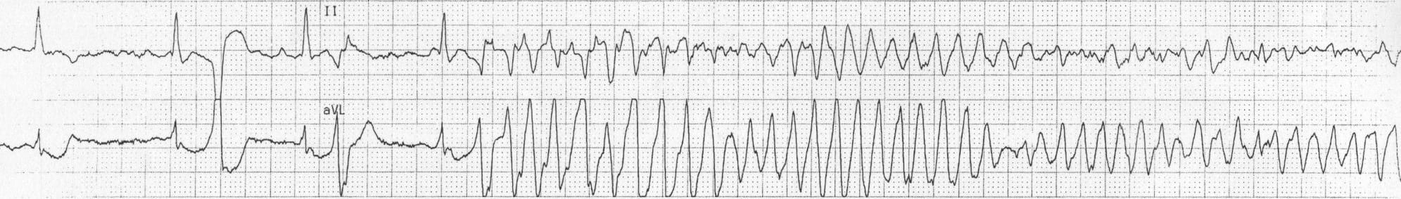 ECG strip Torsades de pointes TDP 2 2