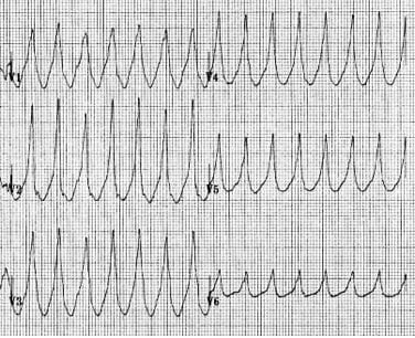 Positive concordance in VT