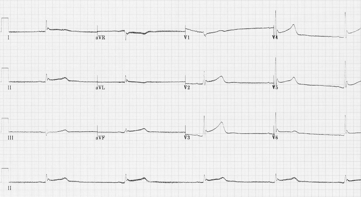 ECG hypothermia shiver artefact bradycardia long QT