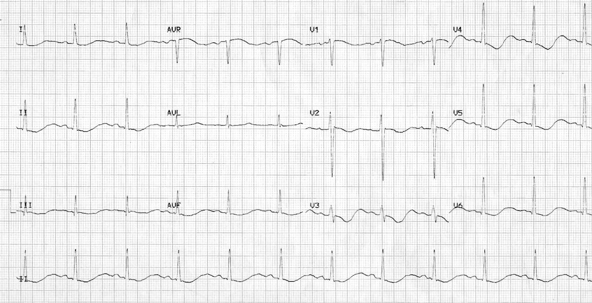 ECG severe hypokalemia serum potassium 1.7