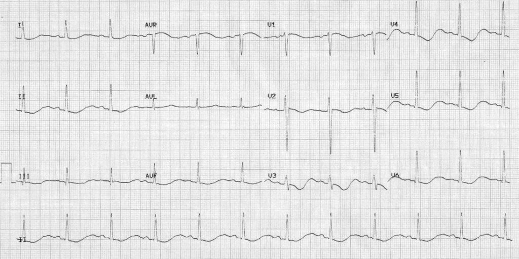 TOP 100 ECG QUIZ LITFL 006 2