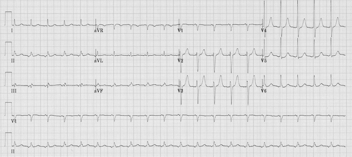 ECG Ectopic atrial tachycardia inverted p waves