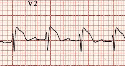 Brugada syndrome in V2