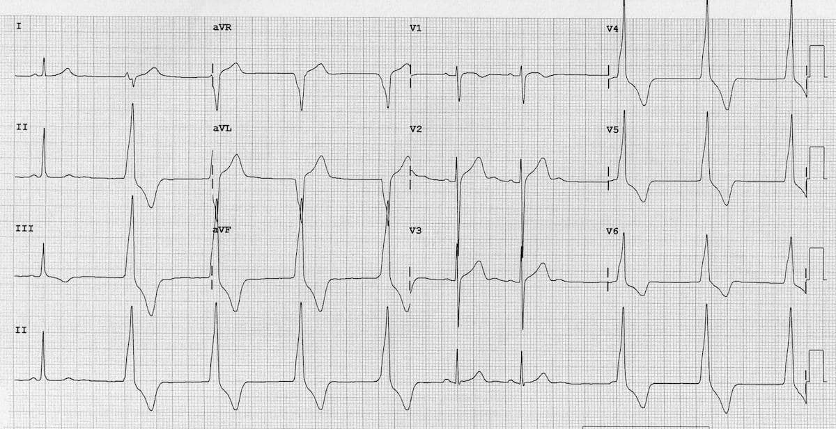 Accelerated Idioventricular Rhythm (AIVR) ECG 1